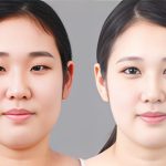 Eyelid Surgery