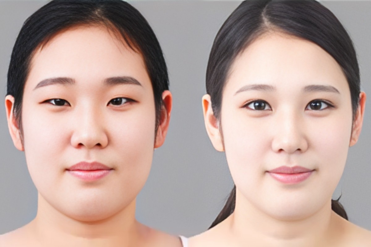 What to Anticipate After Upper Eyelid Surgery