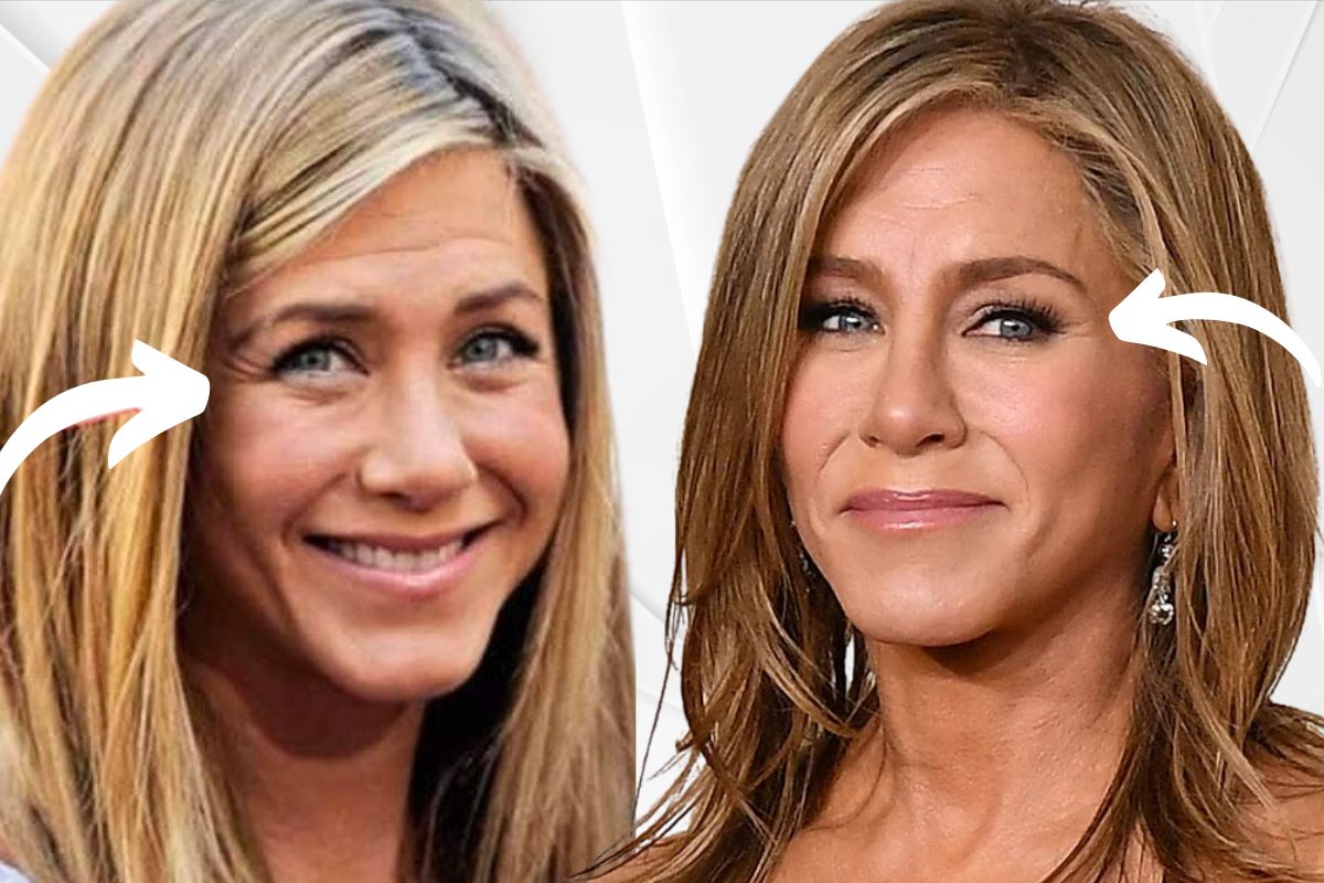 Jennifer Aniston Plastic Surgery 