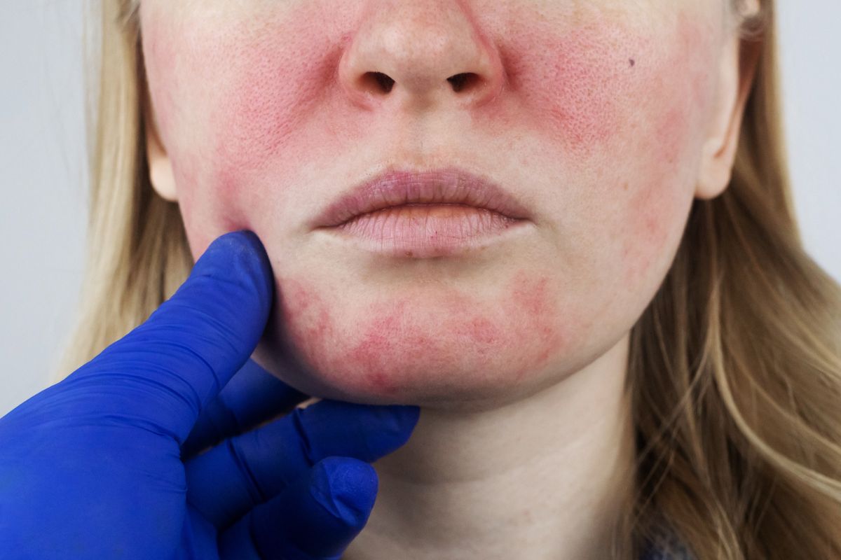 Combating Rosacea and Redness