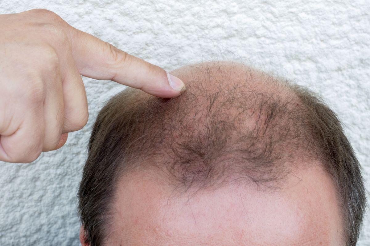 Hair Loss in Men